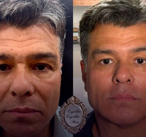 Maurício Mattar realiza harmonização facial e surpreende fãs