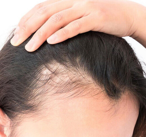 Alopecia Androgenética: Como tratar a queda de cabelo de forma eficiente