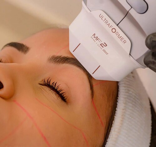 Ultraformer MPT: tecnologia para levantar, firmar e valorizar sua beleza natural
