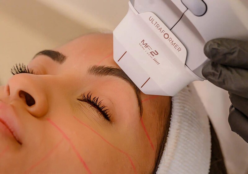 Ultraformer MPT: tecnologia para levantar, firmar e valorizar sua beleza natural