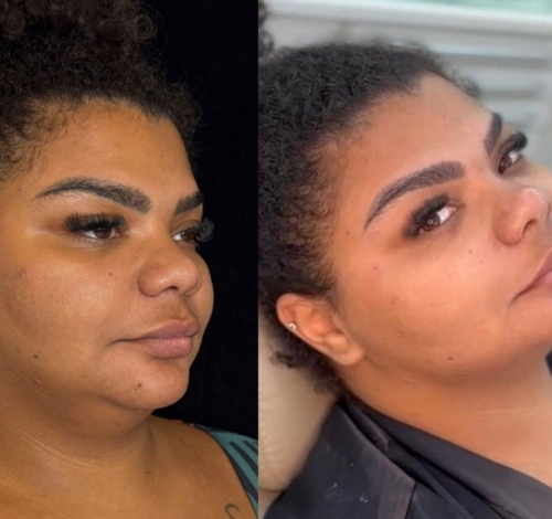 Flora e Babi Cruz apostam em tratamentos estéticos para o Carnaval